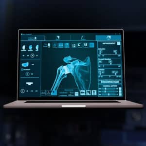 Exactech Equinoxe Planning App Active Intelligence